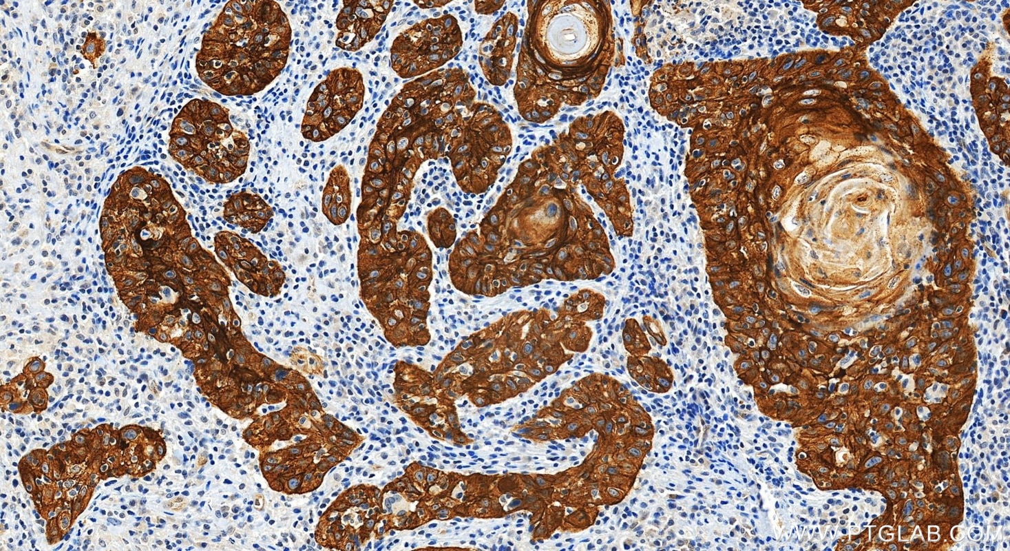 Immunohistochemistry (IHC) staining of human skin cancer tissue using Multi-rAb® TRIM29 Multi-Recombinant antibody (RMX00086)