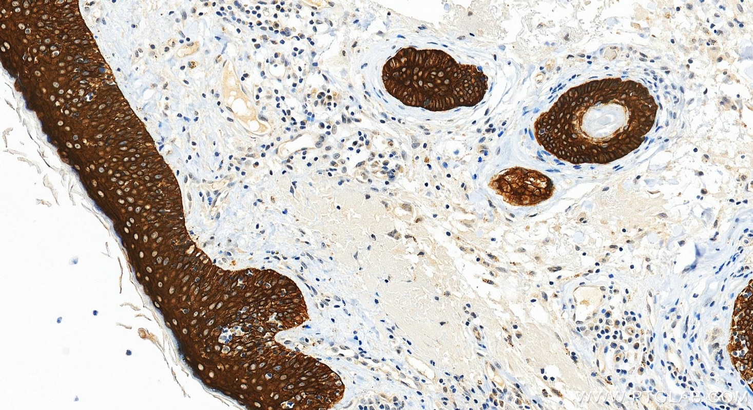 Immunohistochemistry (IHC) staining of human skin cancer tissue using Multi-rAb® TRIM29 Multi-Recombinant antibody (RMX00086)