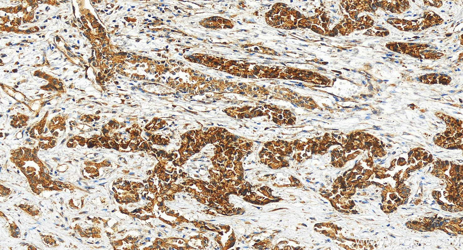 Immunohistochemistry (IHC) staining of human intrahepatic cholangiocarcinoma tissue using TRIM3 Polyclonal antibody (28392-1-AP)