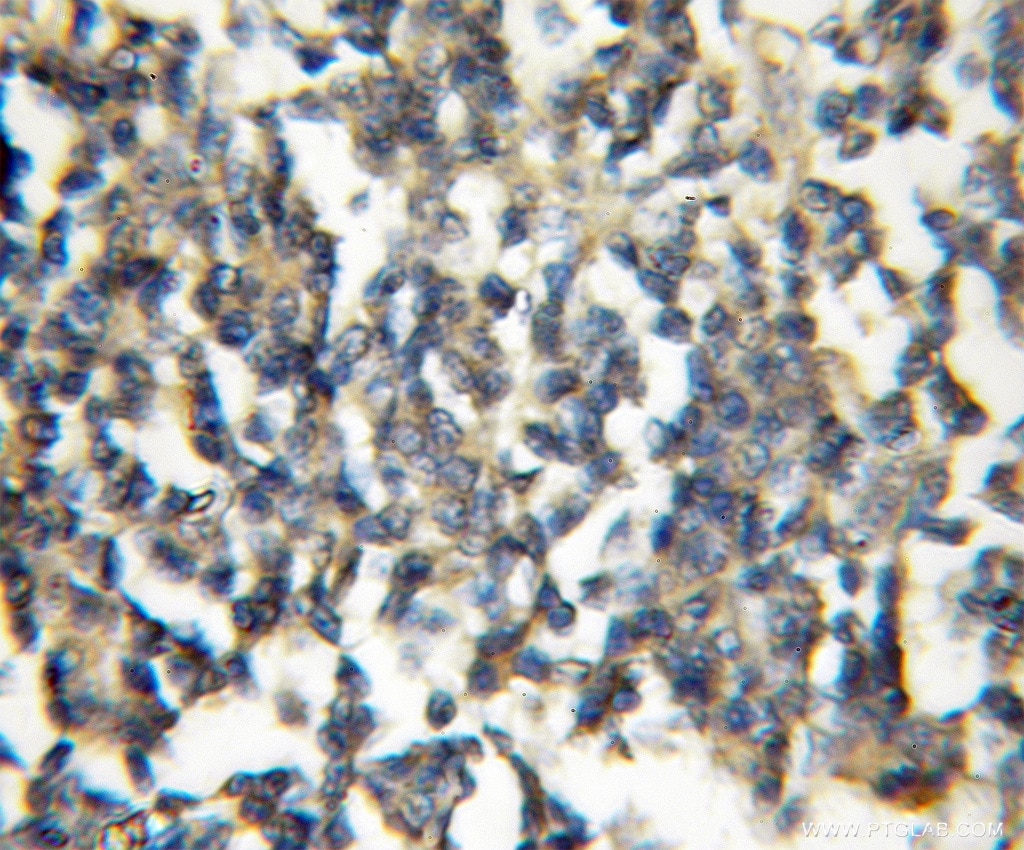 IHC staining of human lymphoma using 10326-1-AP