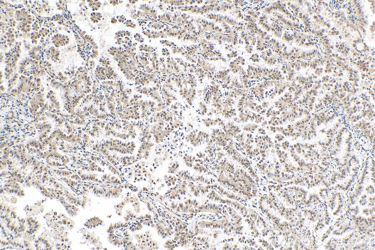 Immunohistochemistry (IHC) staining of human lung cancer tissue using TRIM33 Polyclonal antibody (55374-1-AP)