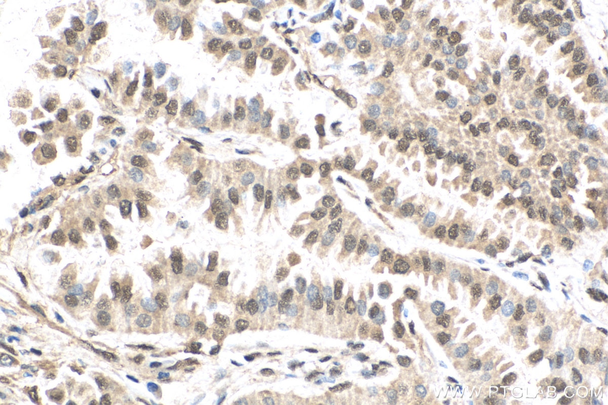 Immunohistochemistry (IHC) staining of human lung cancer tissue using TRIM33 Polyclonal antibody (55374-1-AP)