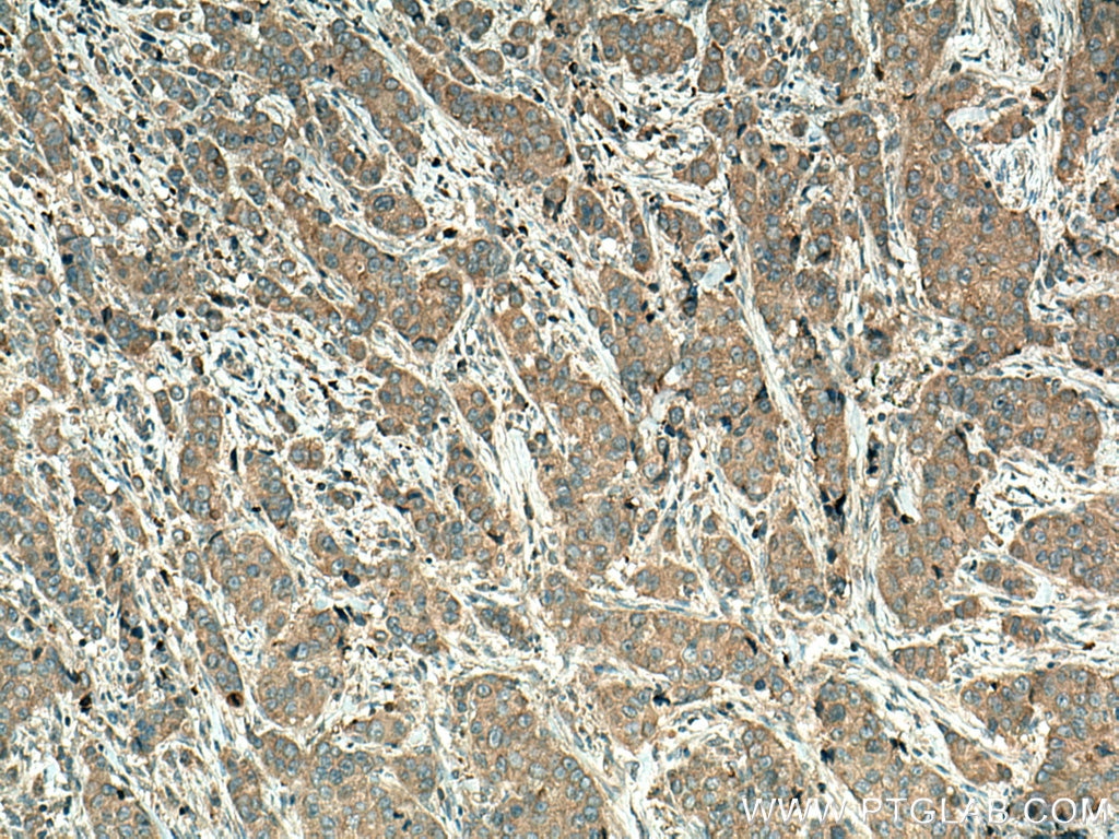 Immunohistochemistry (IHC) staining of human breast cancer tissue using TRIM37 Polyclonal antibody (13037-1-AP)