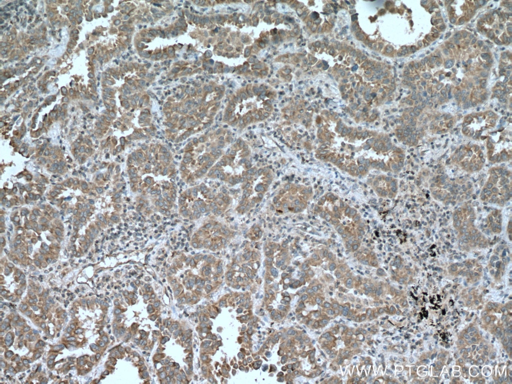 Immunohistochemistry (IHC) staining of human lung cancer tissue using TRIM38 Polyclonal antibody (13405-1-AP)
