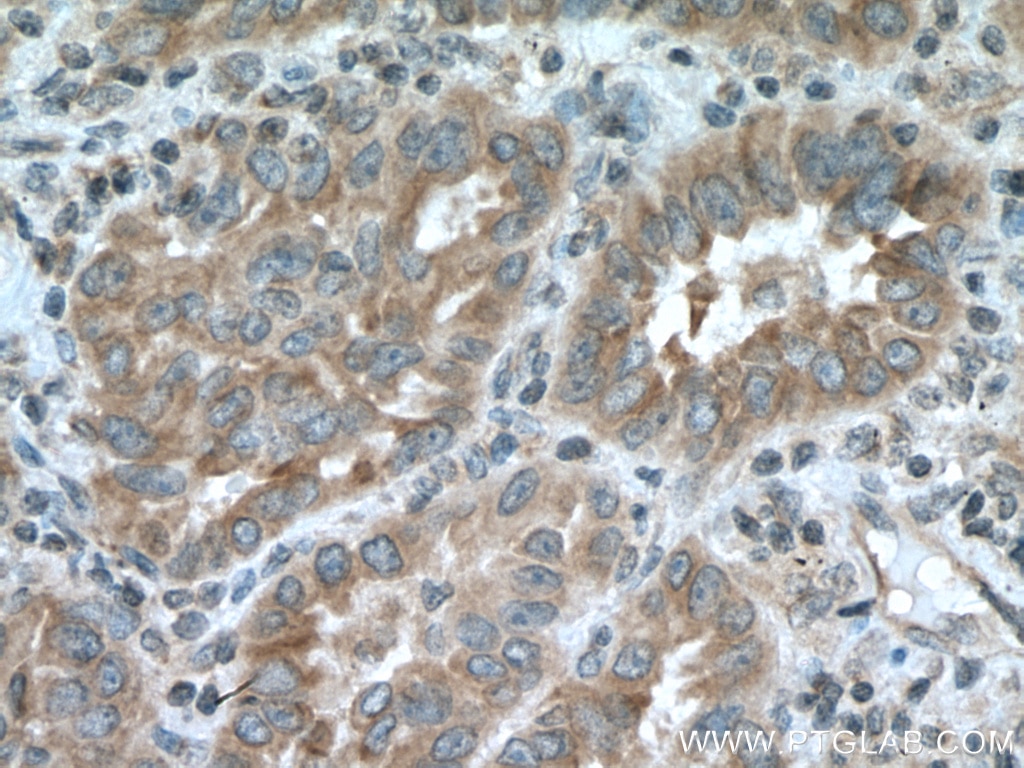 Immunohistochemistry (IHC) staining of human lung cancer tissue using TRIM38 Polyclonal antibody (13405-1-AP)