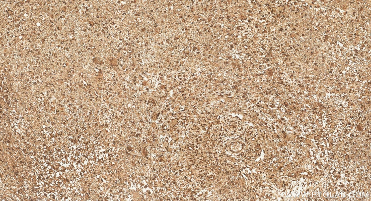 IHC staining of human gliomas using 11511-1-AP Immunohistochemistry (IHC) staining of human gliomas tissue using TRIM44 Polyclonal antibody (11511-1-AP)