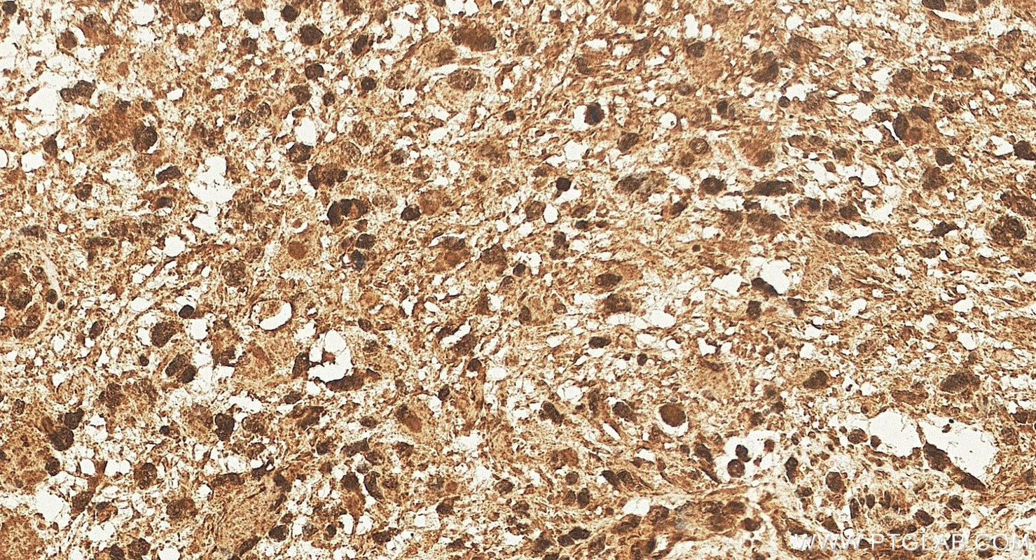 IHC staining of human gliomas using 11511-1-AP Immunohistochemistry (IHC) staining of human gliomas tissue using TRIM44 Polyclonal antibody (11511-1-AP)