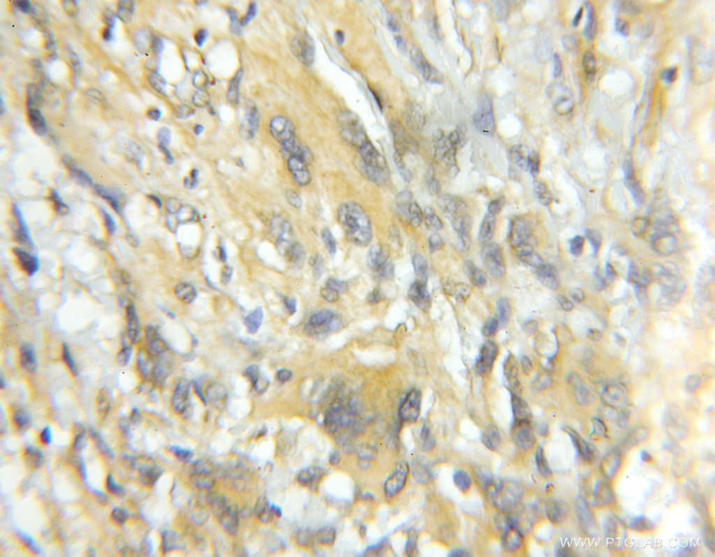 Immunohistochemistry (IHC) staining of human gliomas tissue using TRIM44 Polyclonal antibody (11511-1-AP)