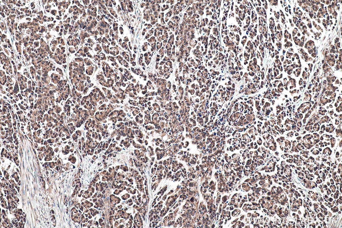 Immunohistochemistry (IHC) staining of human colon cancer tissue using TRIM47 Polyclonal antibody (26885-1-AP)