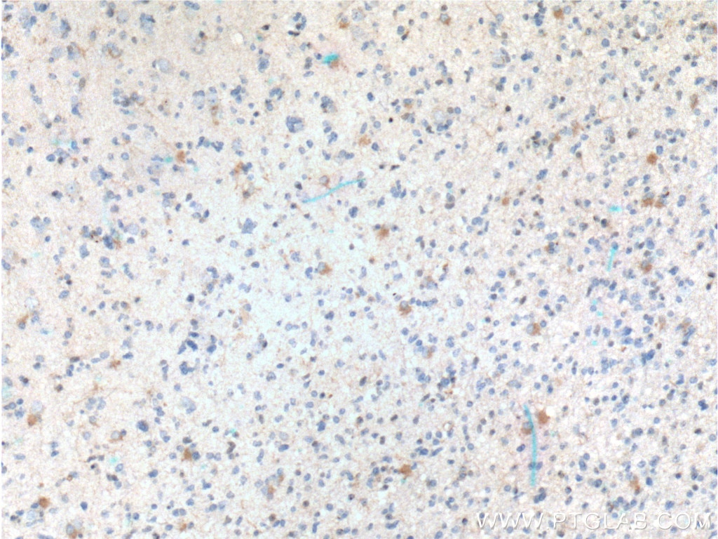 Immunohistochemistry (IHC) staining of human gliomas tissue using TRIM47 Polyclonal antibody (26885-1-AP)