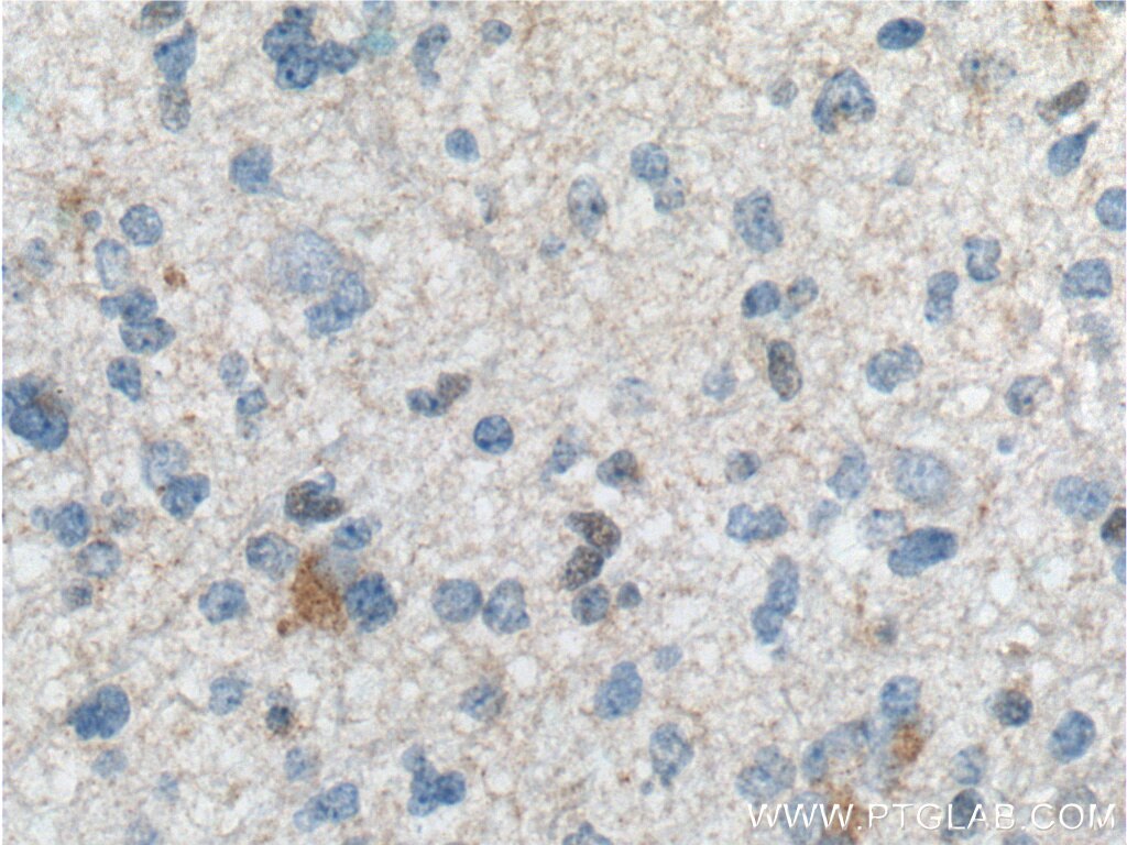 Immunohistochemistry (IHC) staining of human gliomas tissue using TRIM47 Polyclonal antibody (26885-1-AP)