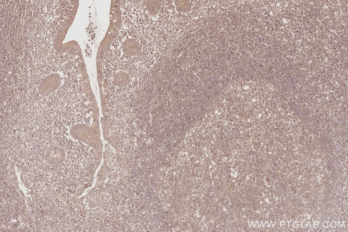 IHC staining of human appendicitis using 67492-1-Ig Immunohistochemistry (IHC) staining of human appendicitis tissue using TRIM5 Monoclonal antibody (67492-1-Ig)