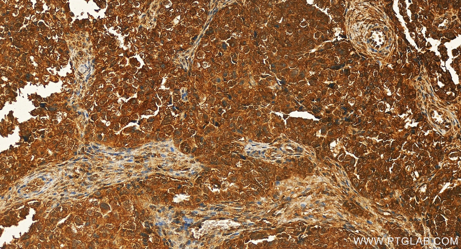 Immunohistochemistry (IHC) staining of human ovary cancer tissue using TRIM52 Polyclonal antibody (20948-1-AP)