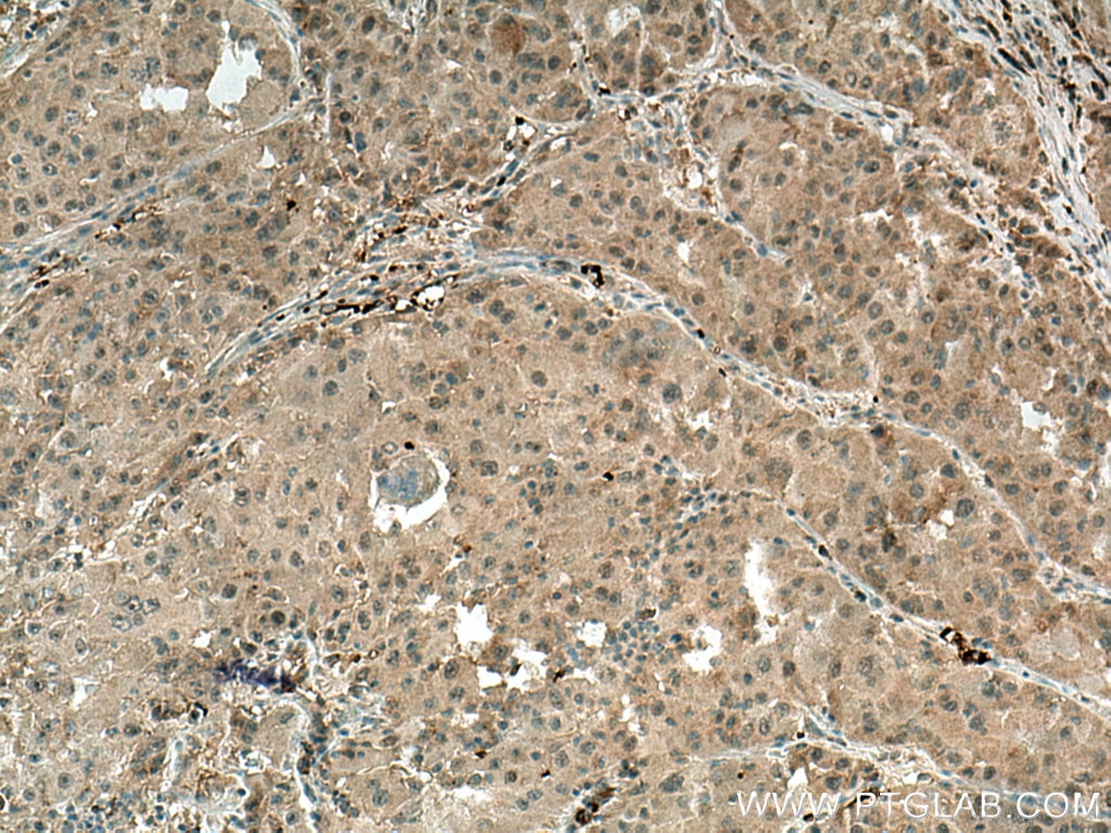 Immunohistochemistry (IHC) staining of human liver cancer tissue using TRIM55 Polyclonal antibody (27274-1-AP)