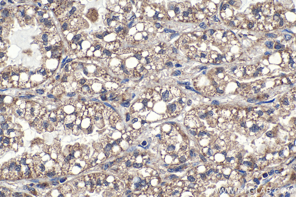 Immunohistochemistry (IHC) staining of human lung cancer tissue using TRIM59 Polyclonal antibody (28575-1-AP)