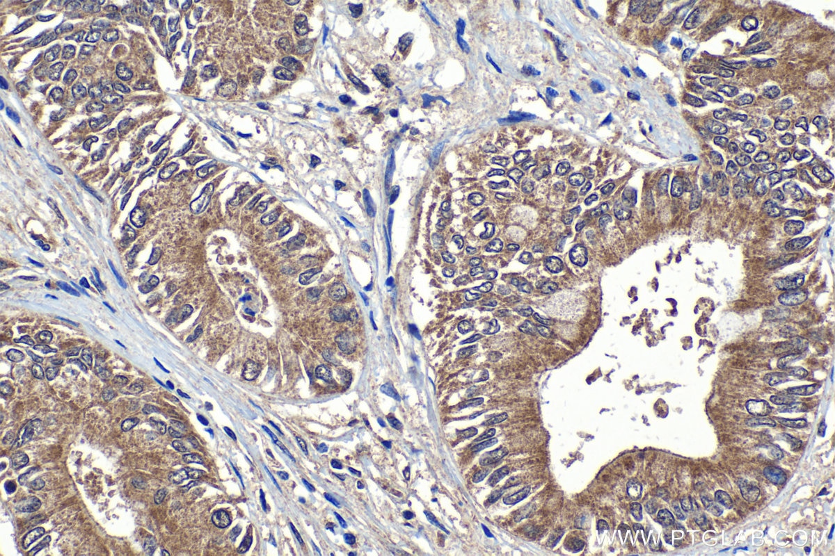 IHC staining of human pancreas cancer using 28575-1-AP