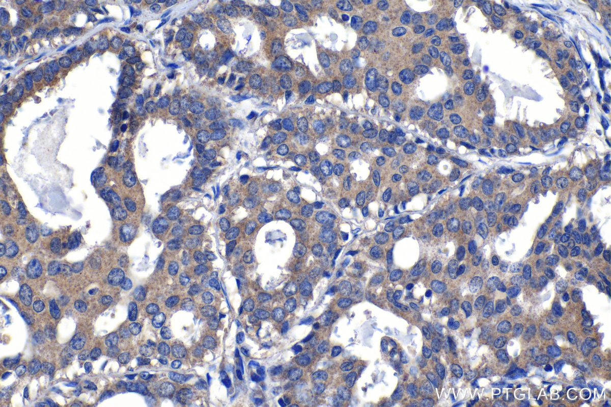 Immunohistochemistry (IHC) staining of human breast cancer tissue using TRIM59 Polyclonal antibody (28575-1-AP)