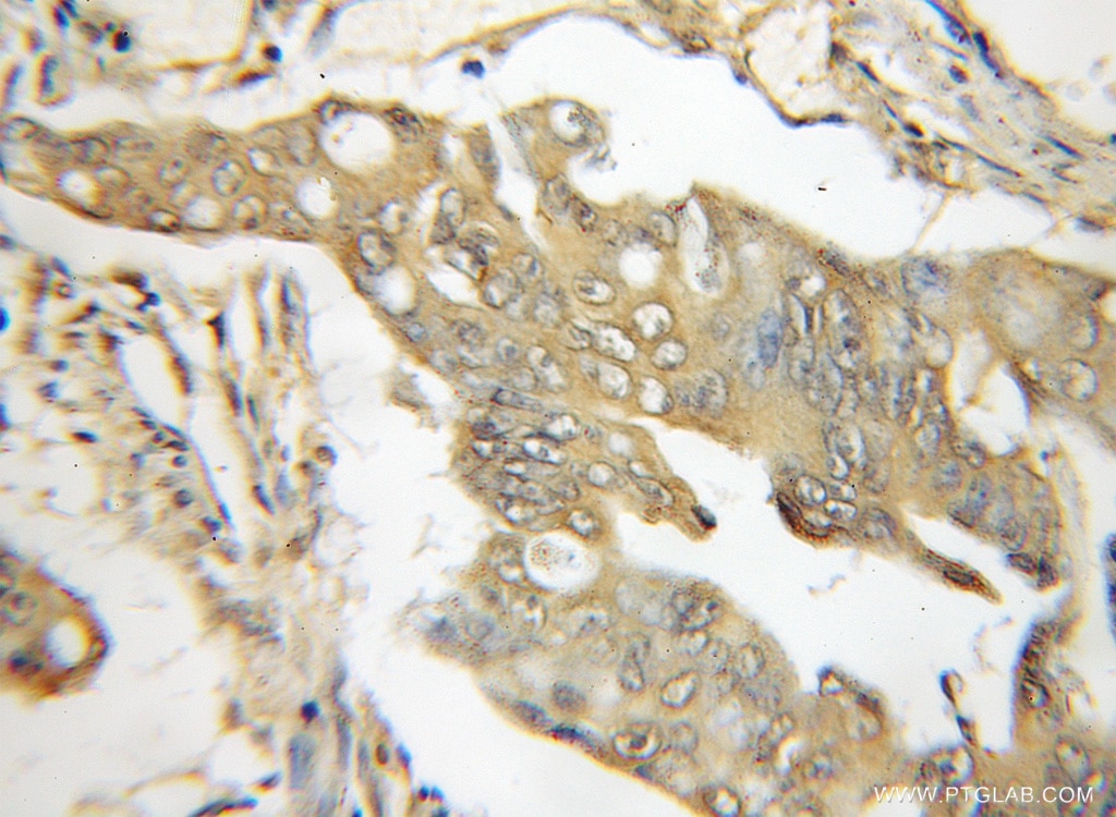 Immunohistochemistry (IHC) staining of human colon cancer tissue using TRIM6 Polyclonal antibody (11953-1-AP)
