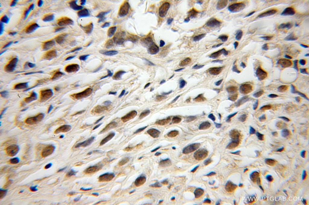 Immunohistochemistry (IHC) staining of human gliomas tissue using TRIM69 Polyclonal antibody (12951-1-AP)