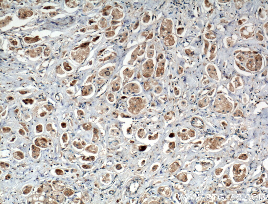 Immunohistochemistry (IHC) staining of human breast cancer tissue using TRIM8 Polyclonal antibody (27463-1-AP)
