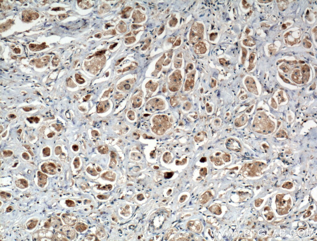 Immunohistochemistry (IHC) staining of human breast cancer tissue using TRIM8 Polyclonal antibody (27463-1-AP)