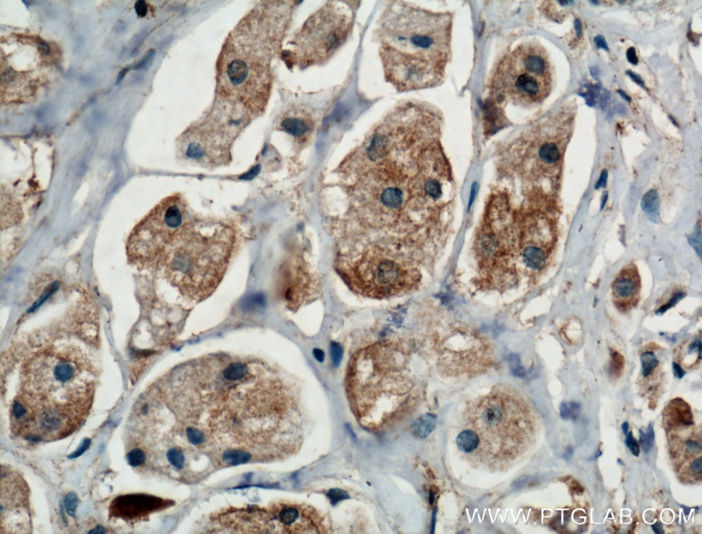 Immunohistochemistry (IHC) staining of human breast cancer tissue using TRIM8 Polyclonal antibody (27463-1-AP)