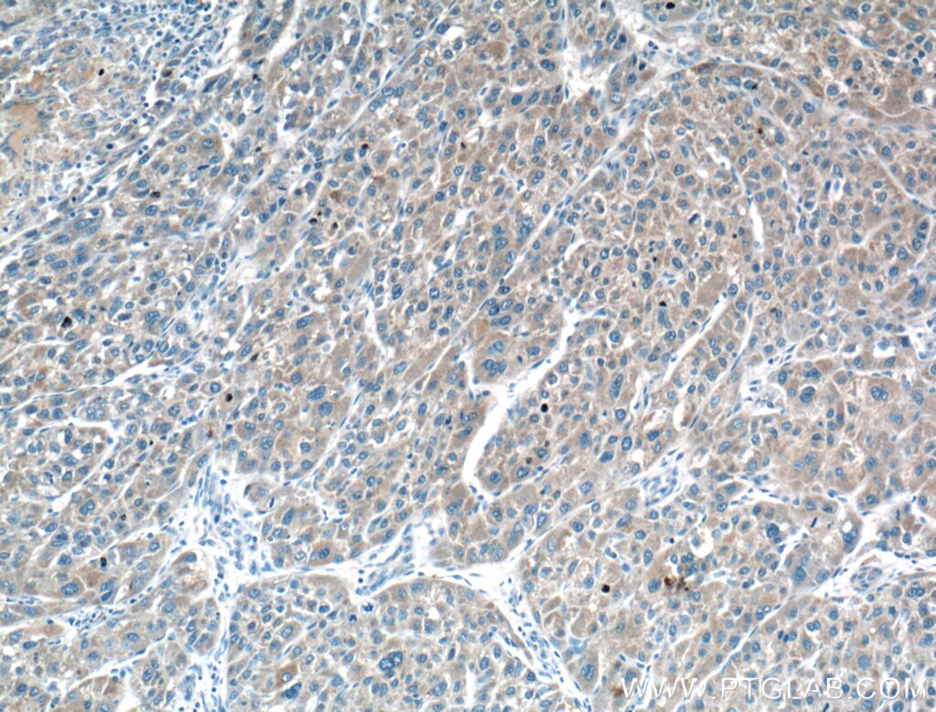 Immunohistochemistry (IHC) staining of human liver cancer tissue using TRIM8 Polyclonal antibody (27463-1-AP)