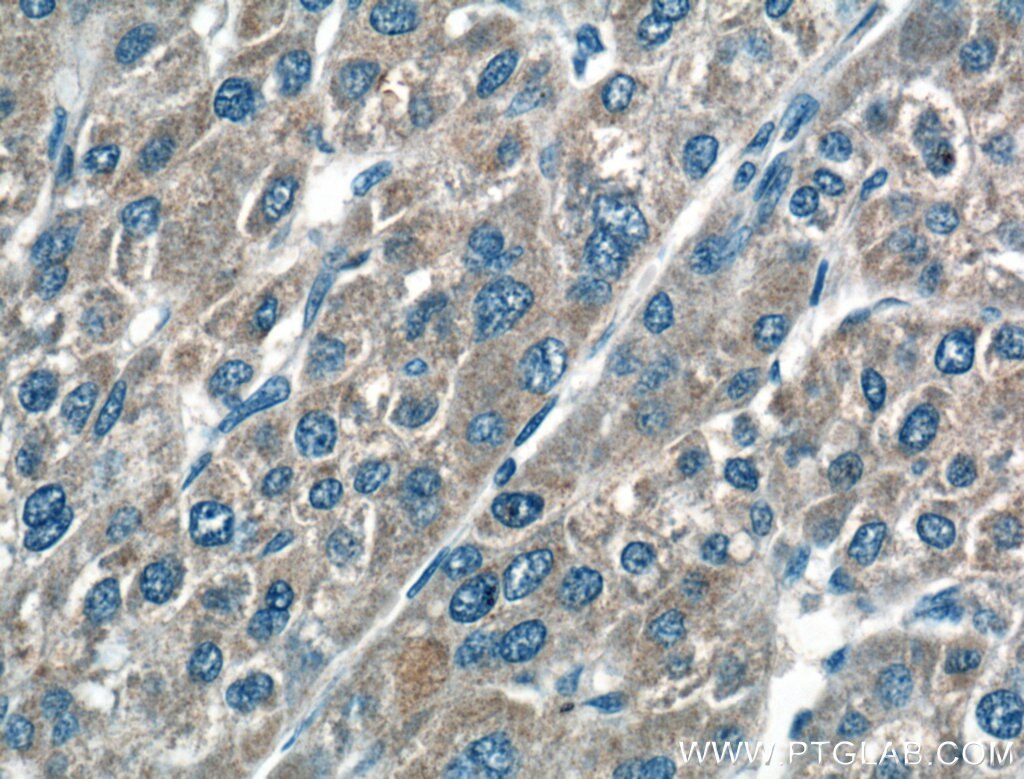 Immunohistochemistry (IHC) staining of human liver cancer tissue using TRIM8 Polyclonal antibody (27463-1-AP)