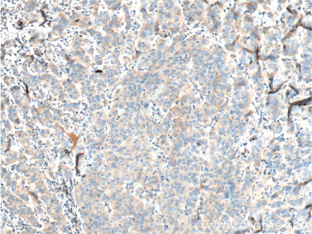 Immunohistochemistry (IHC) staining of human prostate cancer tissue using TRIM9 Polyclonal antibody (10786-1-AP)