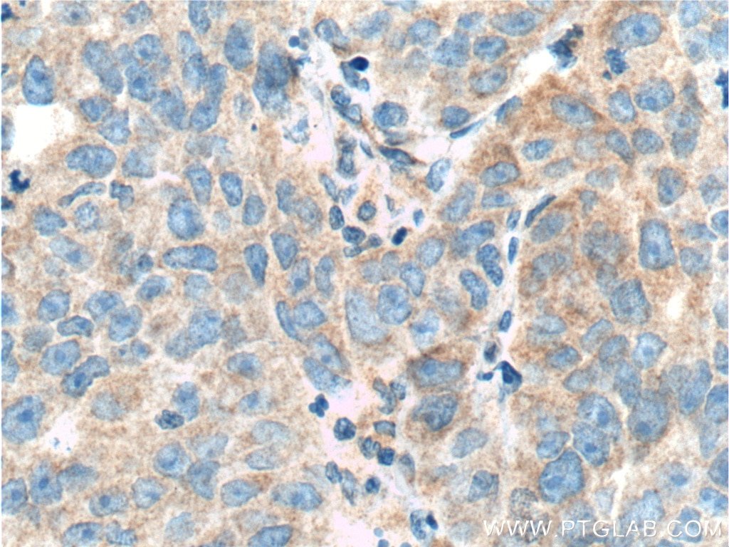 Immunohistochemistry (IHC) staining of human prostate cancer tissue using TRIM9 Polyclonal antibody (10786-1-AP)