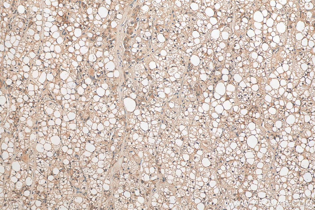 Immunohistochemistry (IHC) staining of human liver cancer tissue using TRIP4 Polyclonal antibody (12324-1-AP)