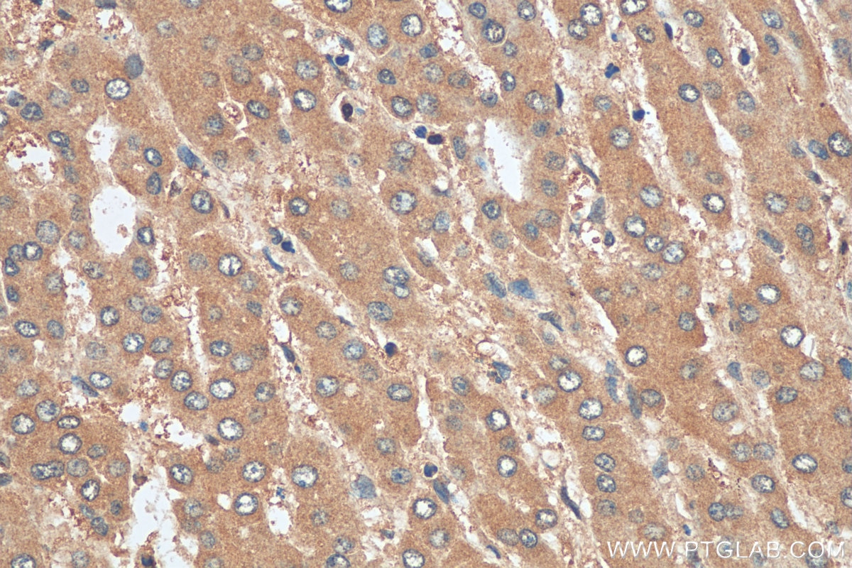 Immunohistochemistry (IHC) staining of human liver cancer tissue using TRIP4 Polyclonal antibody (12324-1-AP)