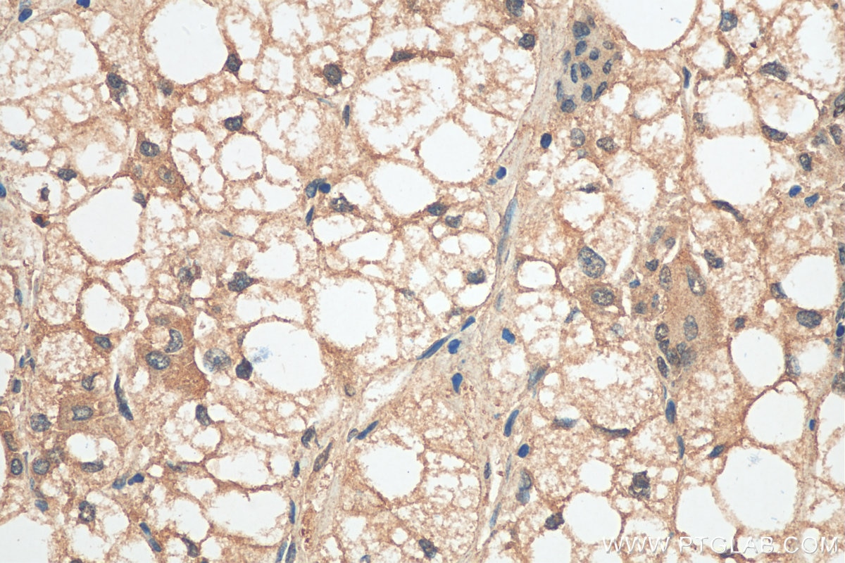 Immunohistochemistry (IHC) staining of human liver cancer tissue using TRIP4 Polyclonal antibody (12324-1-AP)