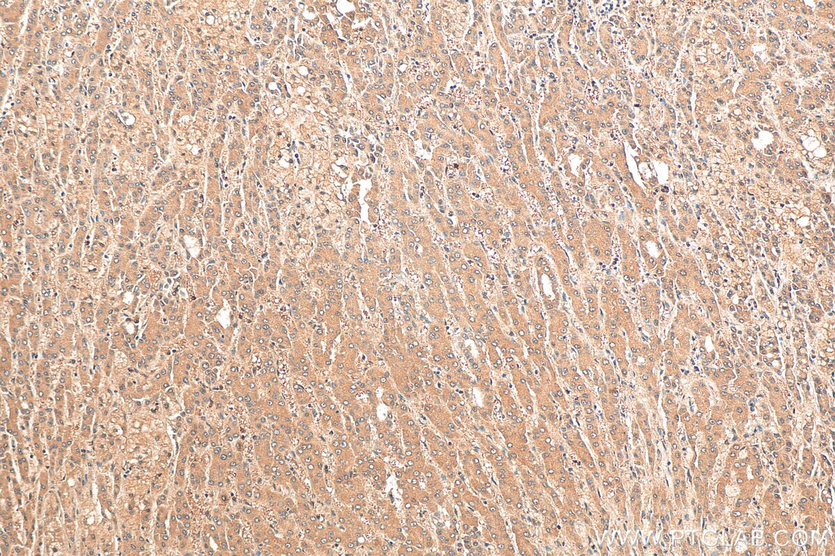 Immunohistochemistry (IHC) staining of human liver cancer tissue using TRIP4 Polyclonal antibody (12324-1-AP)