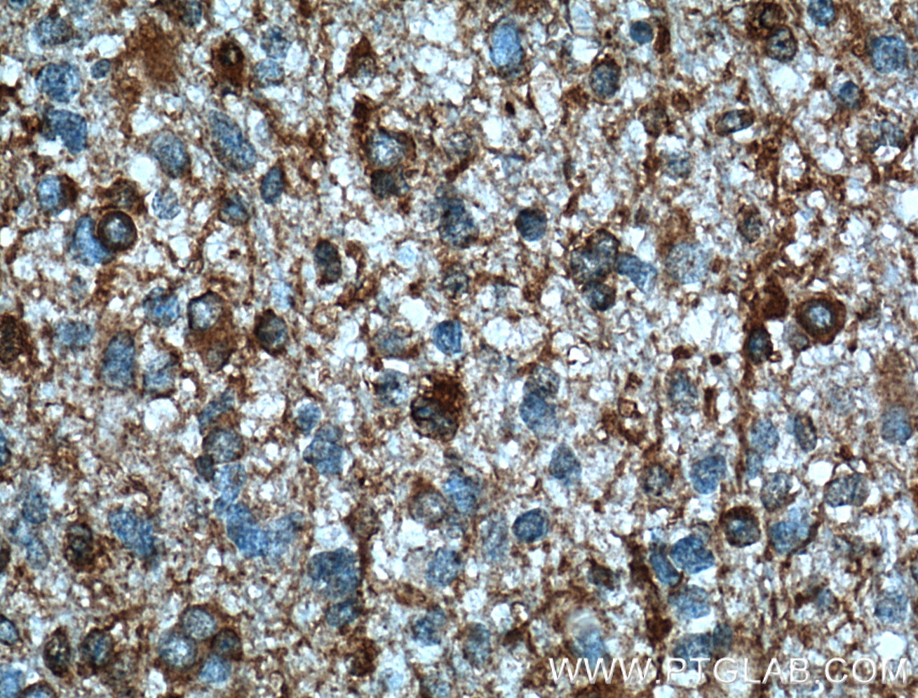 Immunohistochemistry (IHC) staining of human gliomas tissue using TRIP6 Monoclonal antibody (60205-1-Ig)