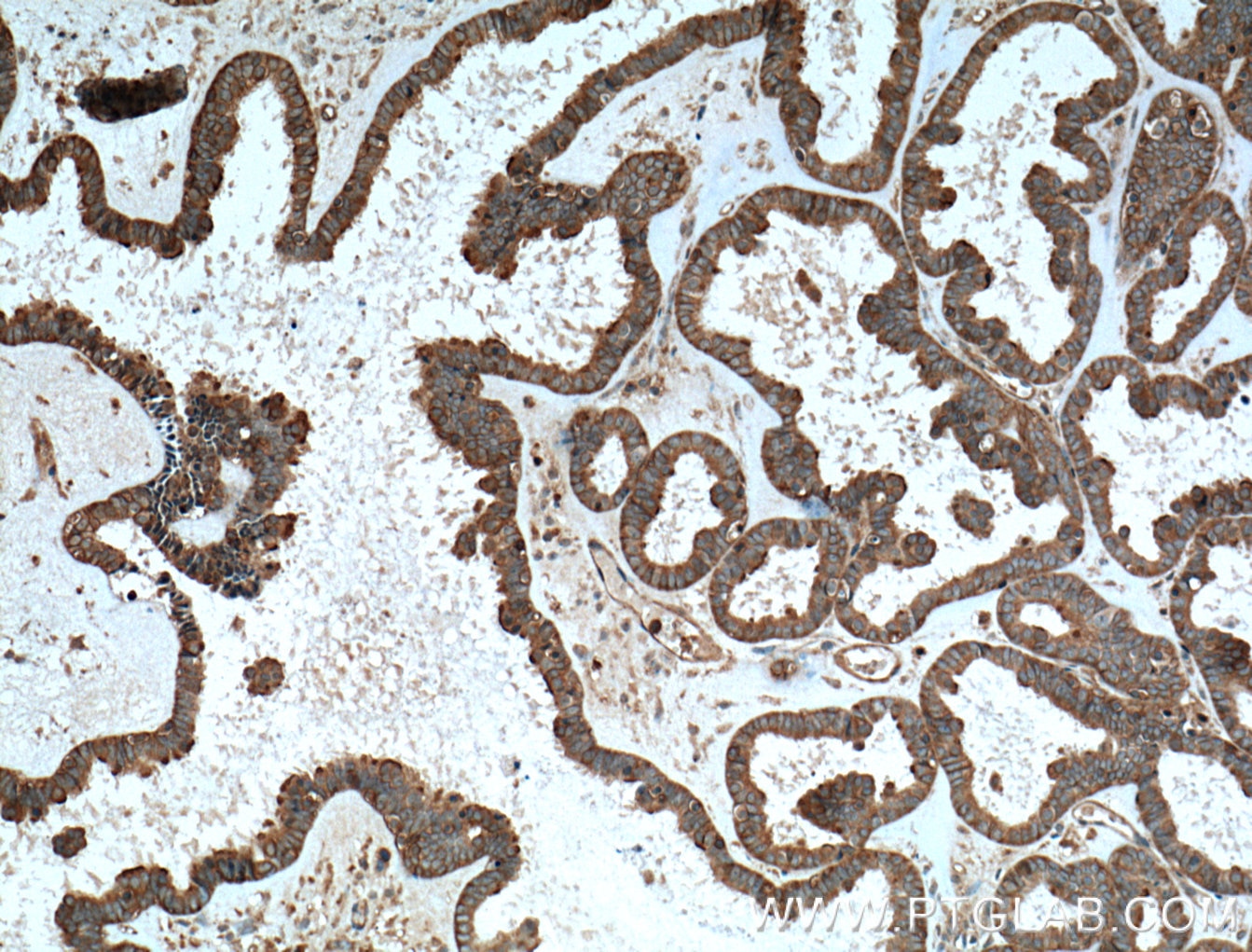 Immunohistochemistry (IHC) staining of human ovary tumor tissue using TRIP6 Monoclonal antibody (60205-1-Ig)