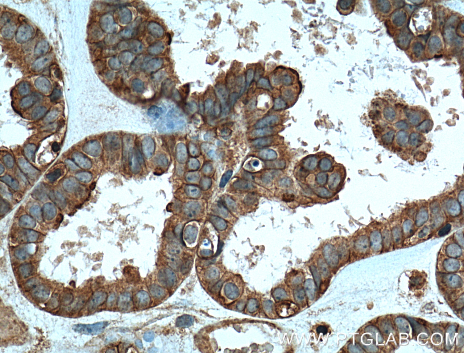 Immunohistochemistry (IHC) staining of human ovary tumor tissue using TRIP6 Monoclonal antibody (60205-1-Ig)