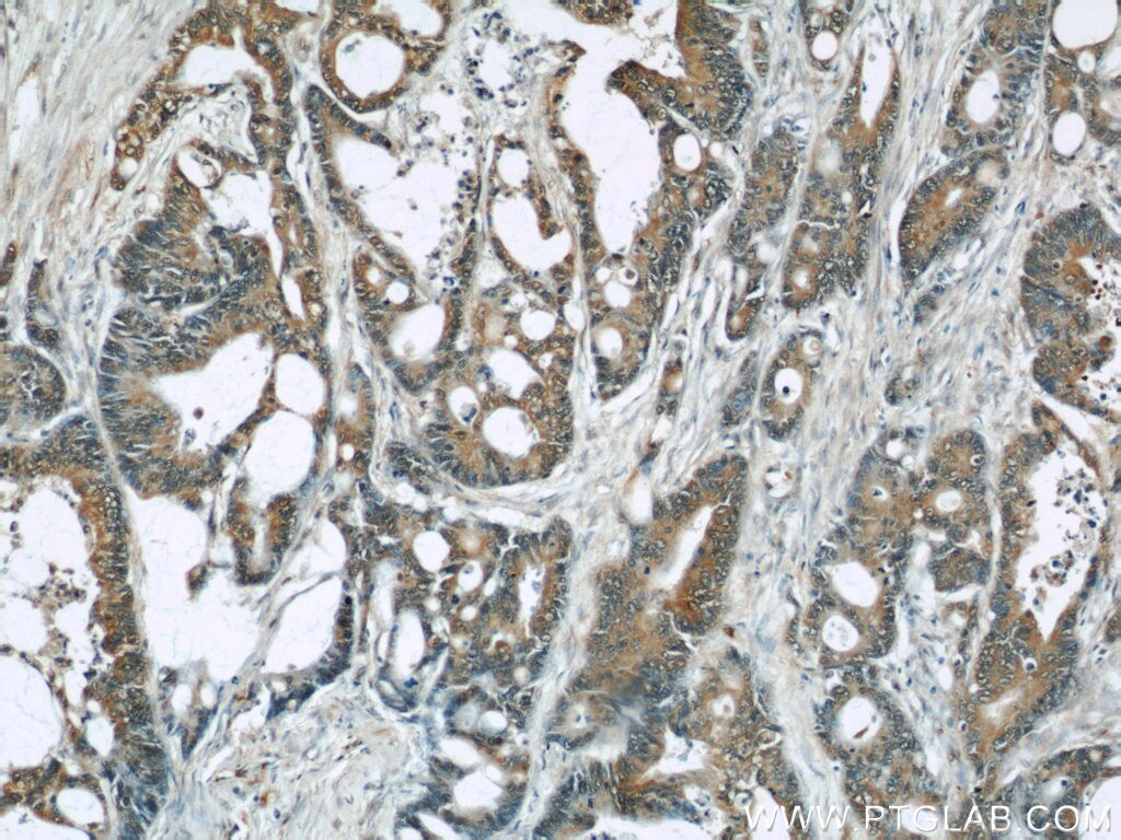 Immunohistochemistry (IHC) staining of human colon cancer tissue using TRIP6 Monoclonal antibody (60205-1-Ig)