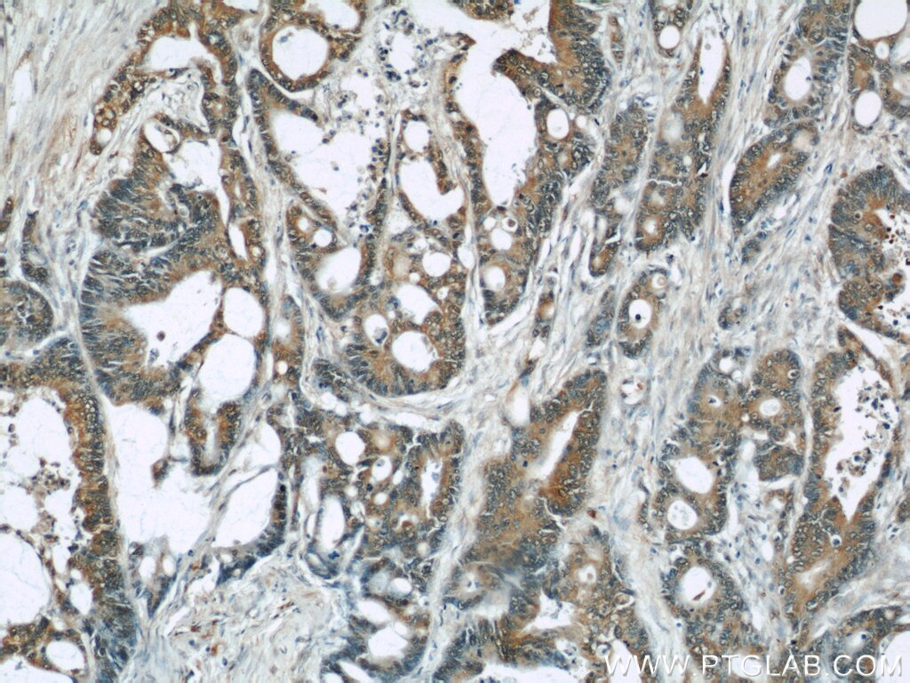 IHC staining of human colon cancer using 60205-1-Ig