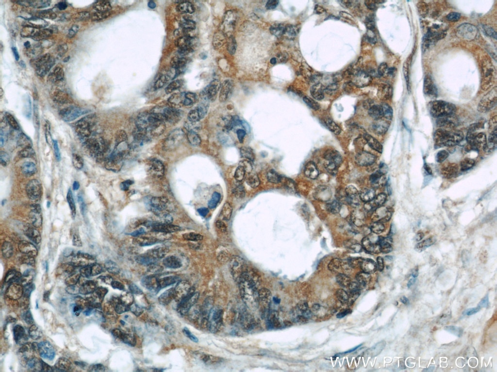 IHC staining of human colon cancer using 60205-1-Ig