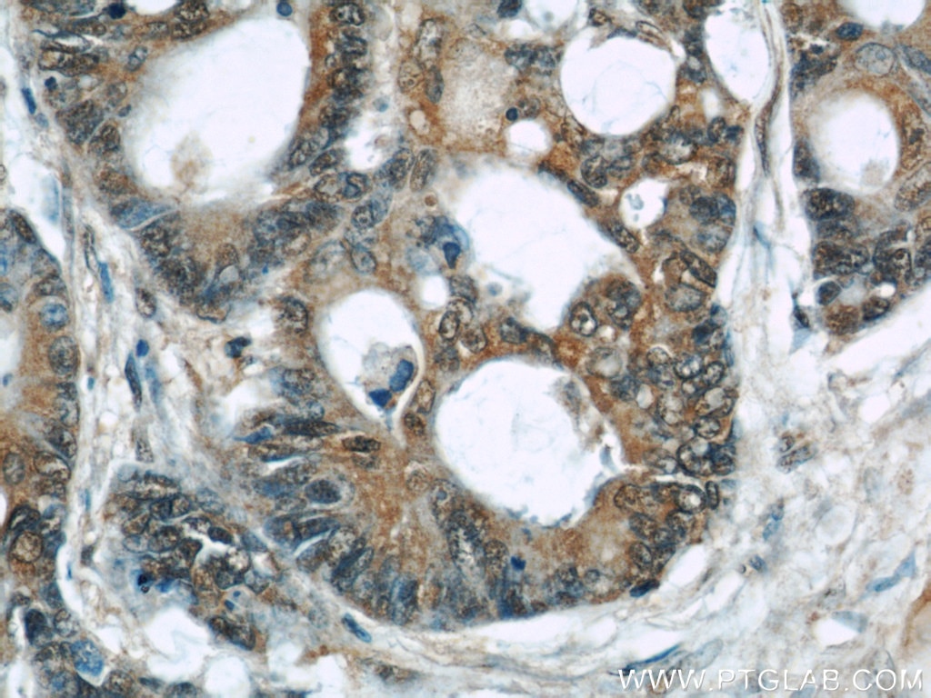 Immunohistochemistry (IHC) staining of human colon cancer tissue using TRIP6 Monoclonal antibody (60205-1-Ig)