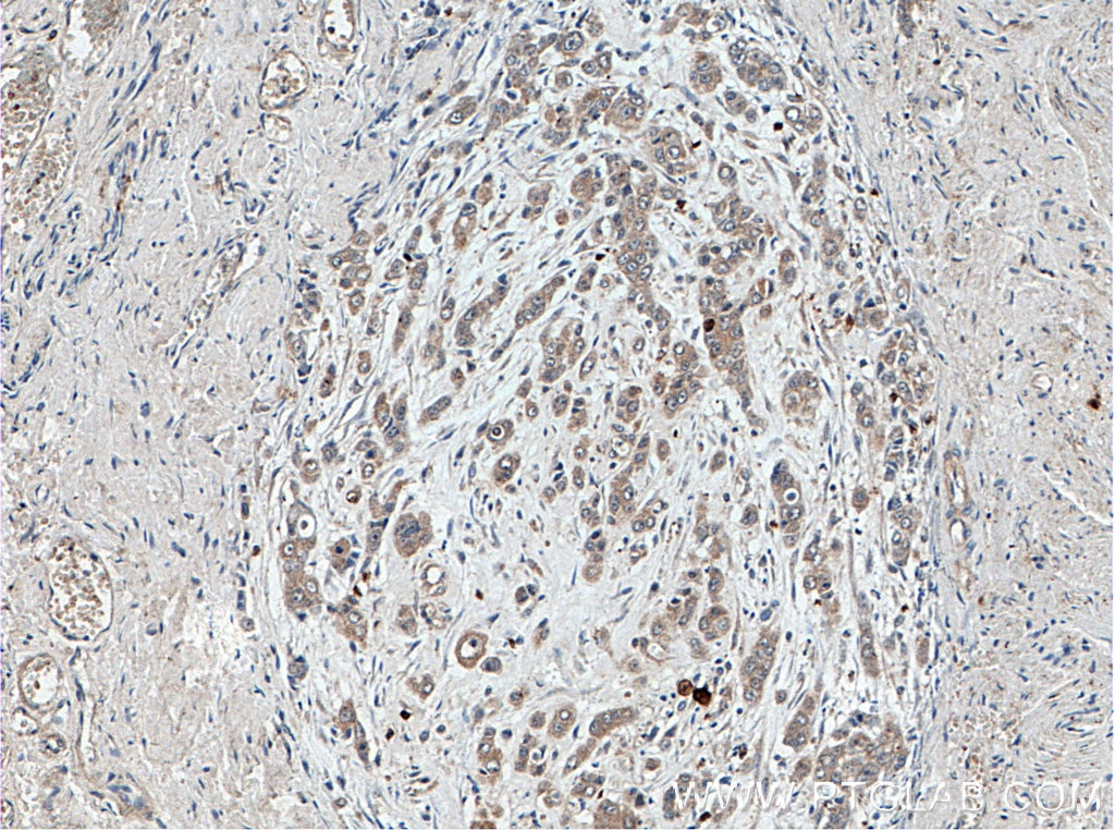 Immunohistochemistry (IHC) staining of human colon cancer tissue using TRMT1 Polyclonal antibody (14970-1-AP)
