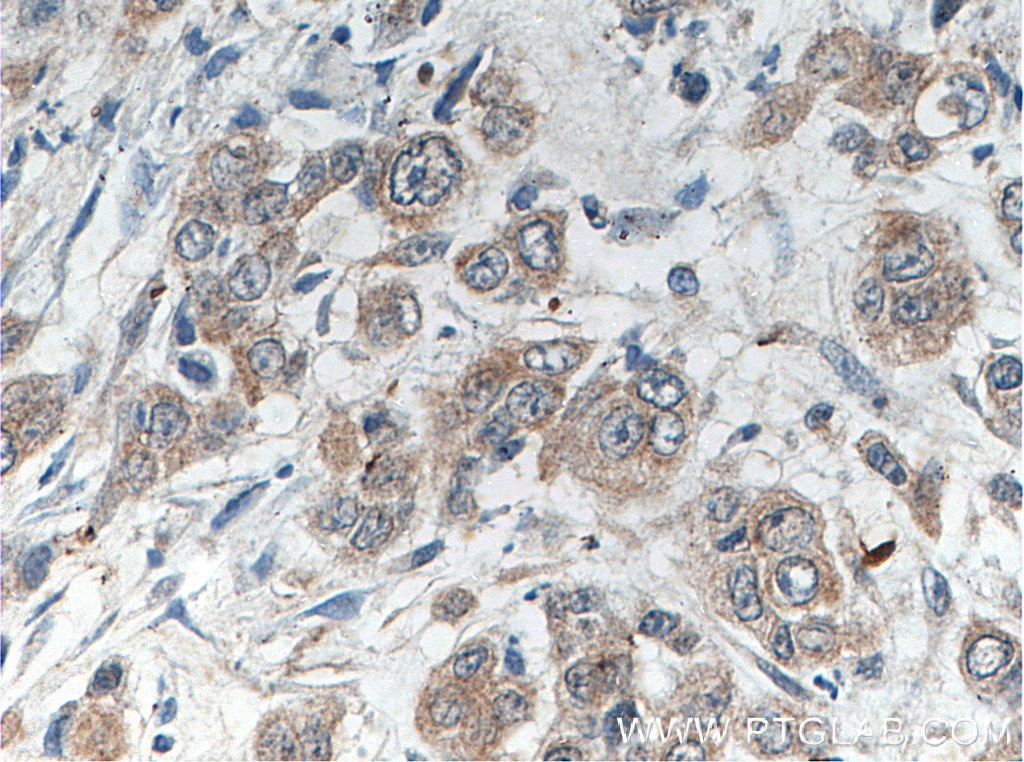 IHC staining of human colon cancer using 14970-1-AP