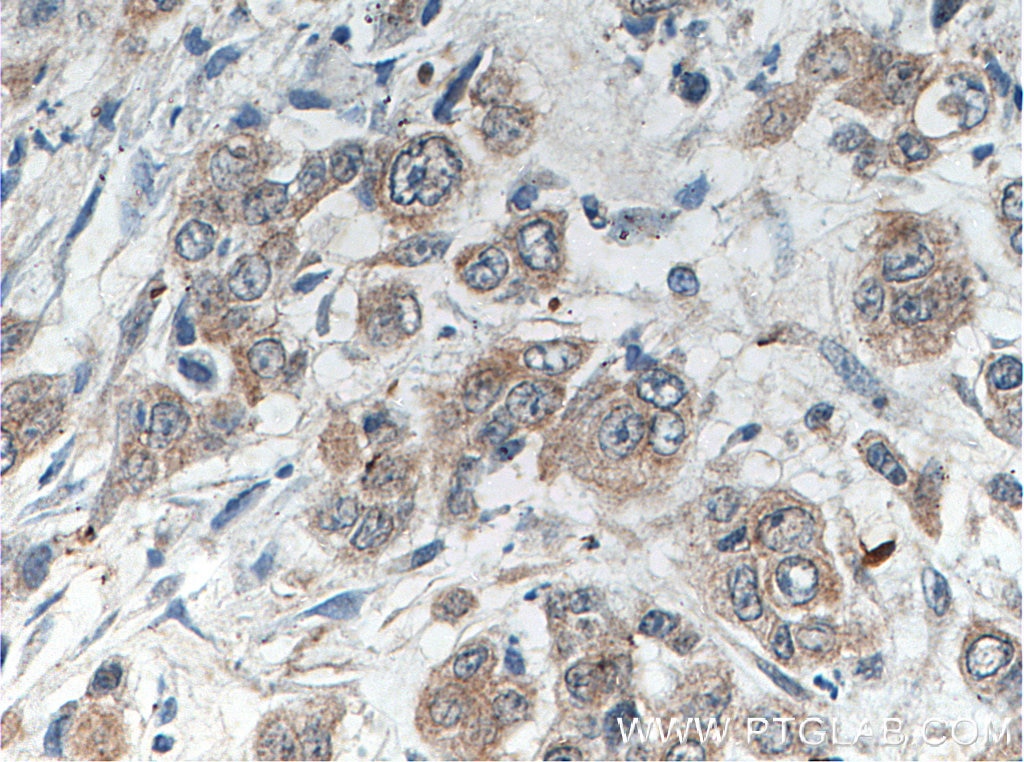 Immunohistochemistry (IHC) staining of human colon cancer tissue using TRMT1 Polyclonal antibody (14970-1-AP)