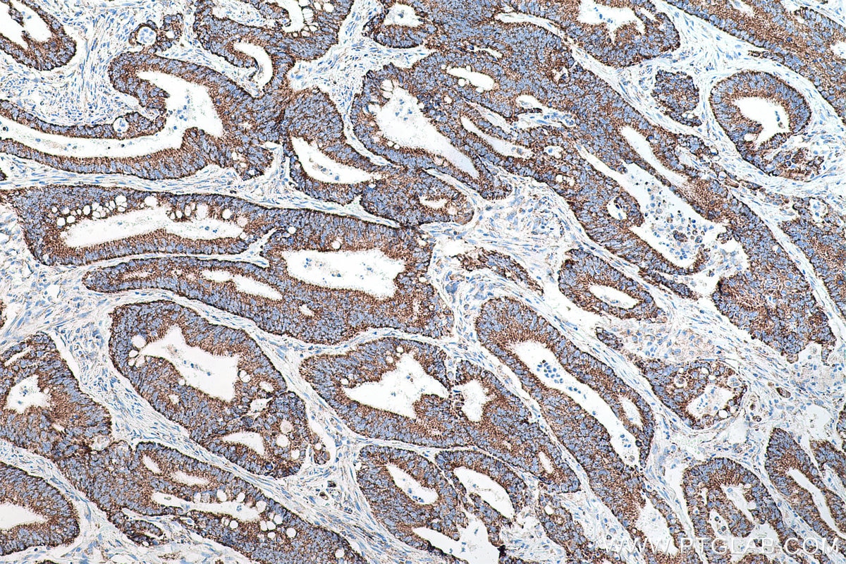 Immunohistochemistry (IHC) staining of human colon cancer tissue using TRMT10C Polyclonal antibody (29087-1-AP)