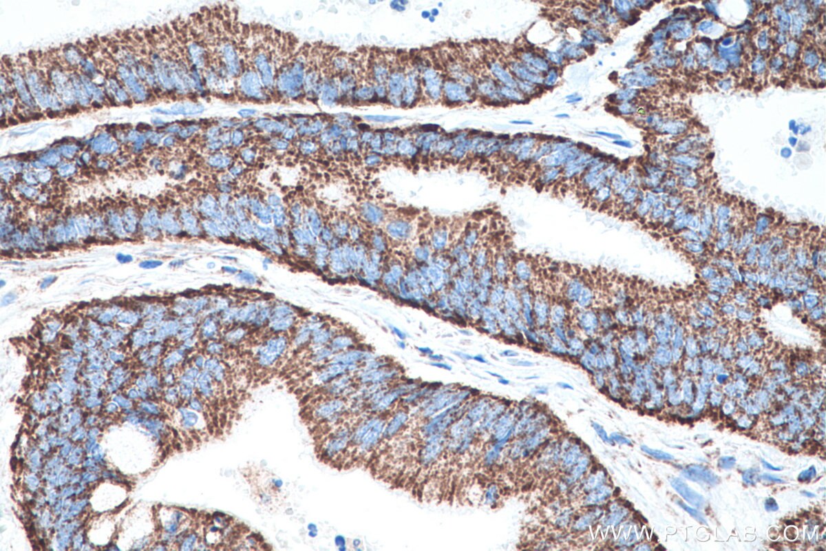 Immunohistochemistry (IHC) staining of human colon cancer tissue using TRMT10C Polyclonal antibody (29087-1-AP)