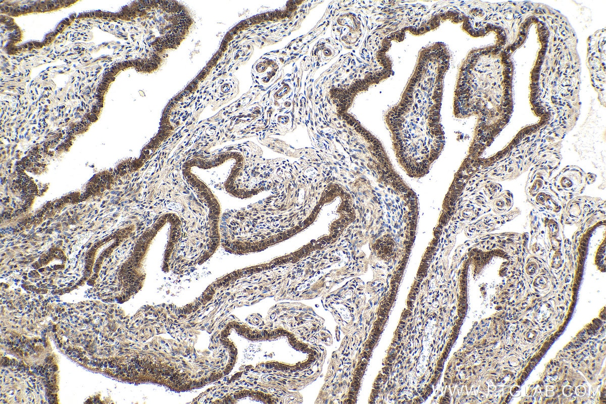 Immunohistochemistry (IHC) staining of human ovary tumor tissue using TRMT112 Polyclonal antibody (26472-1-AP)