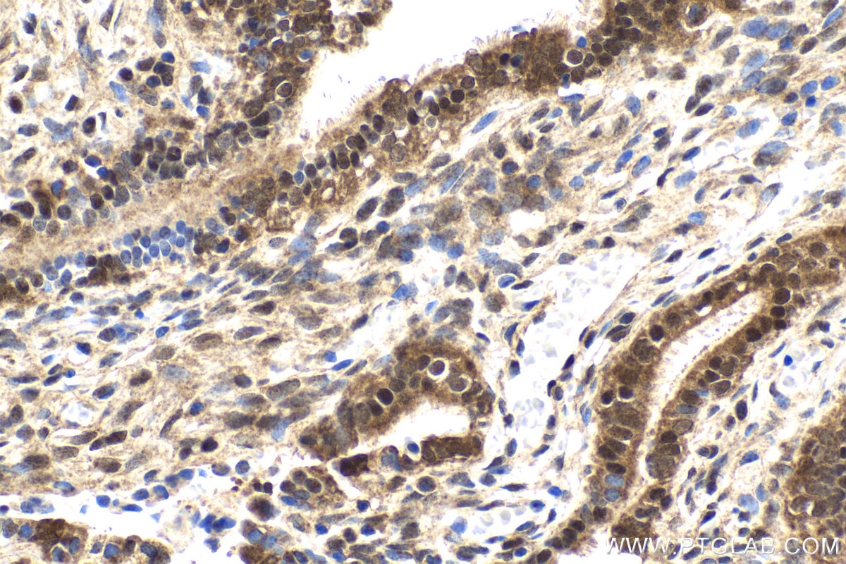 Immunohistochemistry (IHC) staining of human ovary tumor tissue using TRMT112 Polyclonal antibody (26472-1-AP)