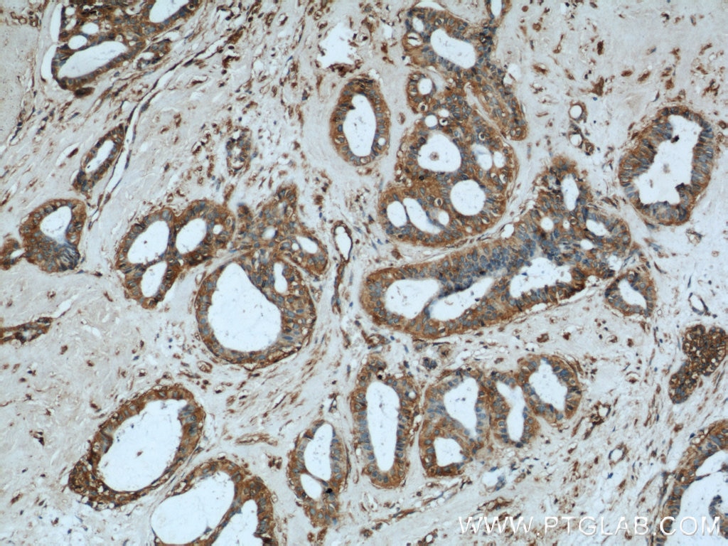 Immunohistochemistry (IHC) staining of human breast cancer tissue using HTF9C Polyclonal antibody (16199-1-AP)