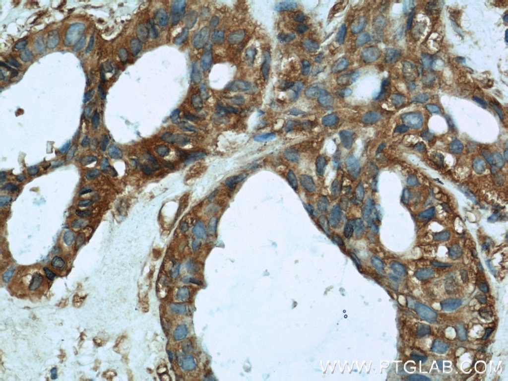Immunohistochemistry (IHC) staining of human breast cancer tissue using HTF9C Polyclonal antibody (16199-1-AP)